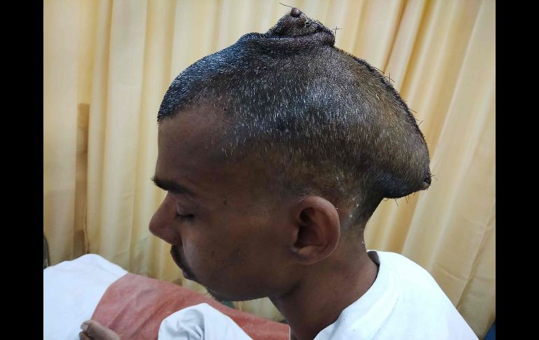 Un equipo de cirujanos indios extrajo el tumor de casi dos kilos durante una compleja y delicada operación de siete horas efectuada el 14 de febrero pasado. Imagen difundida hoy de Pal tras la operación. AFP/Department of Neurosurgery Topiwala National Medical College