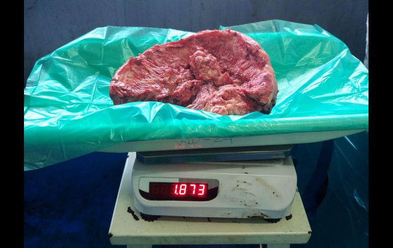 Tras la operación, se observó que el tumor pesaba 1.873 kilos, el más pesado que se haya extraído de un paciente sobreviviente, indicó el hospital BYL Nair. AFP/Department of Neurosurgery Topiwala National Medical College
