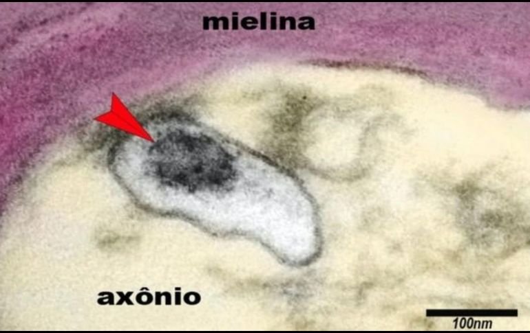 La imagen muestra un axón de una neurona en el cerebro de un niño con síndrome inflamatorio multisistémico pediátrico (SIM-P). La flecha señala al virus SARS-CoV-2 en una vesícula en el citoplasma del axón. ELIA CALDINI