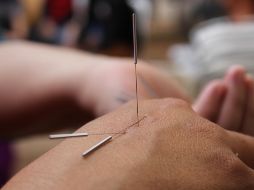 La acupuntura es una práctica que utiliza la inserción de agujas finas en la piel para aliviar dolores, manejar el estrés, y “equilibrar el flujo de energía”. PIXABAY
