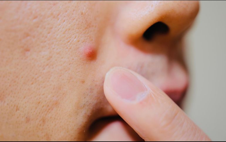 Conoce algunos mitos y realidades del acné en la mujer adulta. ISTOCK.