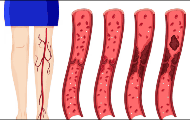 Los Centros para el Control y Prevención de Enfermedades (CDC) de Estados Unidos identifican dos tipos de trombosis: la venosa profunda y la embolia pulmonar. ESPECIAL/FREEPIK