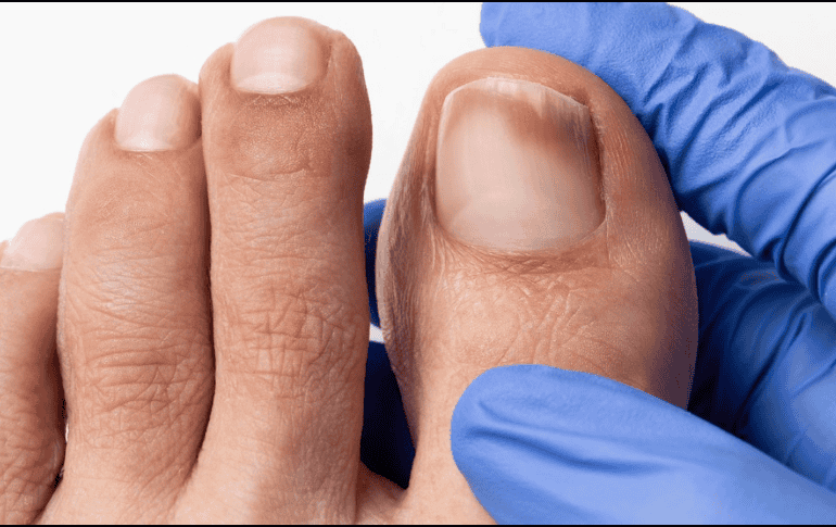 Los hongos en la piel y las uñas pueden ser comunes y son tratables. ESPECIAL