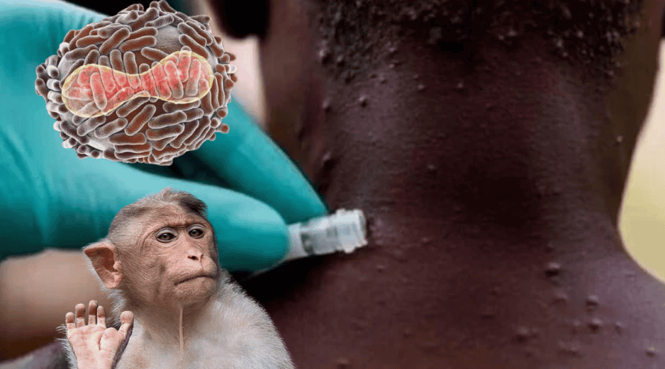 La gran mayoría de casos reportados de la viruela el mono en África fueron registrados en la República del Congo, con casi 18 mil. EFE/ ARCHIVO/ CANVA