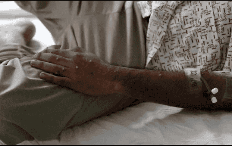 Este contagio, de acuerdo con el gobierno de Morelos, corresponde a la variante ll de Mpox. EFE/ARCHIVO