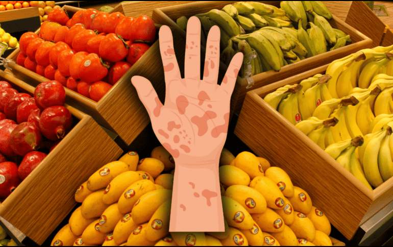 La psoriasis es una condición que genera inflamación y descamación en la piel, lo que puede causar picazón, enrojecimiento y molestias significativas. EL INFORMADOR / ARCHIVO