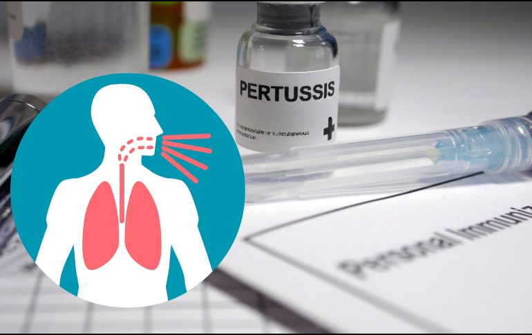 De acuerdo con la SSa, la tos ferina es una infección respiratoria aguda altamente contagiosa causada por la bacteria Bordetella pertussis. ESPECIAL / CANVA