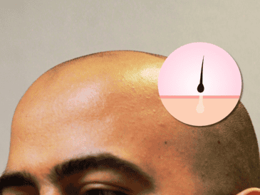 La alopecia androgenética afecta al 50% de los hombres mayores de 50 años y se vuelve cada vez más común con la edad. EL INFORMADOR / ARCHIVO