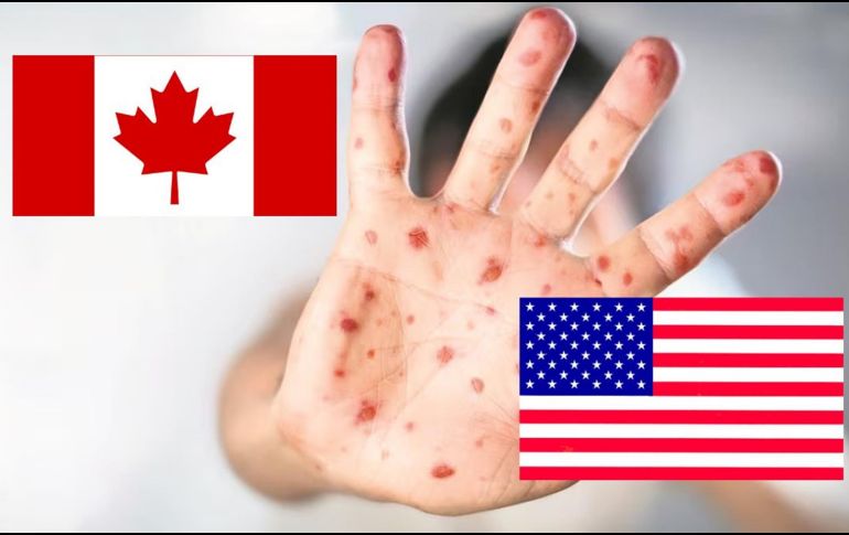 En Estados Unidos se han registrado 800 casos de sarampión durante 2025. ESPECIAL / SUN