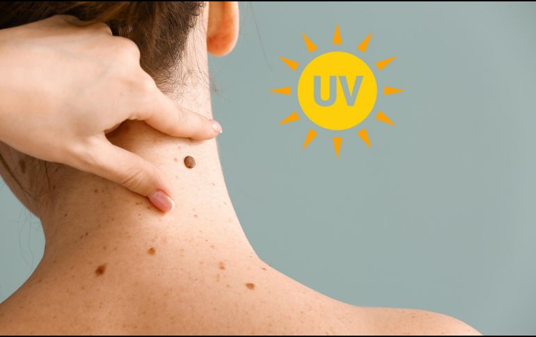 El melanoma, un tumor cutáneo grave, se asemeja a un lunar, pero a menudo con las siguientes características: asimetría, bordes irregulares, varios colores, agrandamiento o cambio de aspecto. ESPECIAL / CANVA