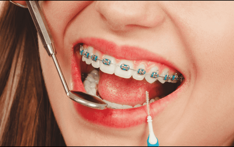 El uso de brackets no está estrictamente limitado por la edad, pero sí por el estado de salud bucal del paciente.  CANVA