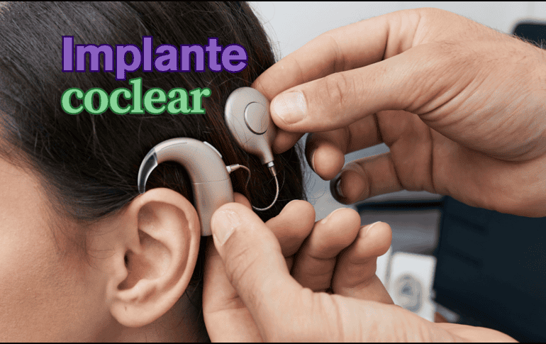 La colocación de este dispositivo es un procedimiento seguro, con una tasa baja de complicaciones intra y postoperatorias. ESPECIAL / CANVA