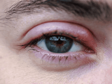 ¿Por qué salen perrillas en los ojos? UNSPLASH / E. MARSAN
