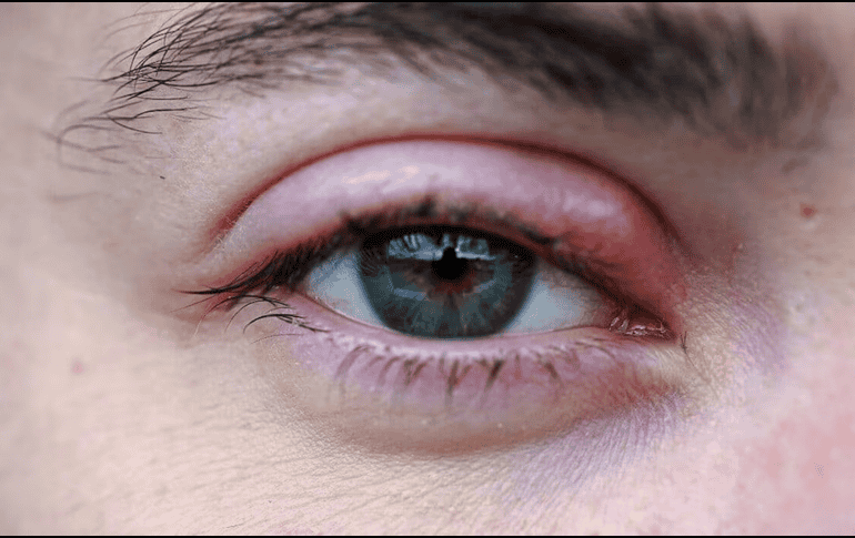 ¿Por qué salen perrillas en los ojos? UNSPLASH / E. MARSAN
