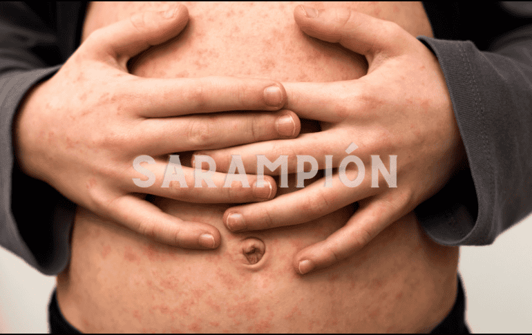 La tarde de este miércoles se confirmó otra muerte más por sarampión en el estado de Chihuahua. ESPECIAL / CANVA