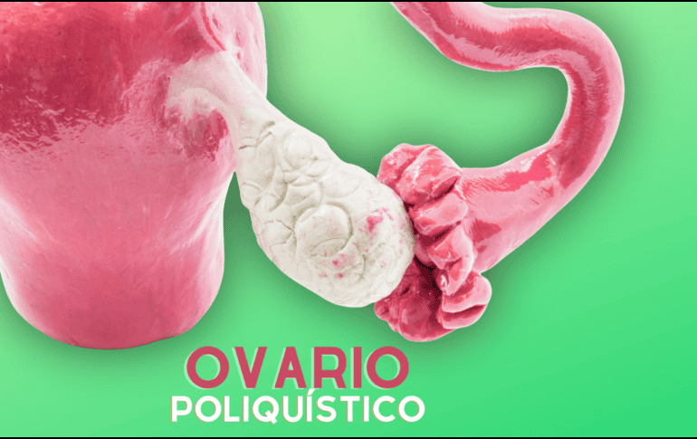 Dentro de los elementos centrales para el desarrollo de ovario poliquístico está la resistencia a la insulina. ESPECIAL / CANVA