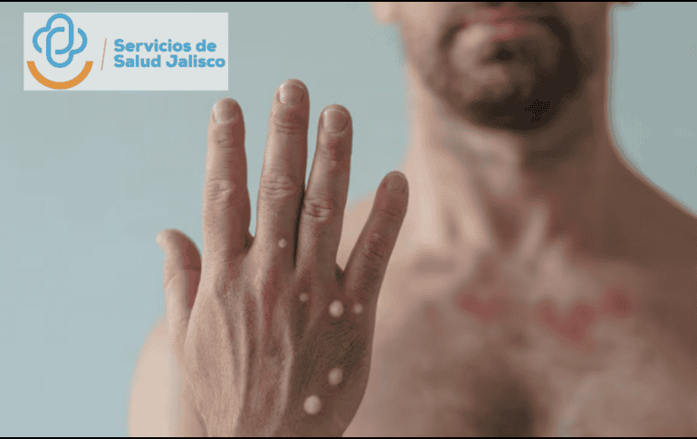 La mayoría de los casos se concentran en la metrópoli, en Puerto Vallarta y Ciudad Guzmán, dijo el titular de la SSJ. CANVA / SUN / ARCHIVO