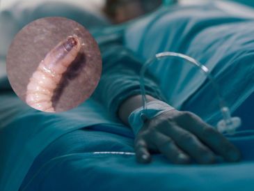 Al menos 5 de los casos perdieron la vida mientras recibían tratamiento, aunque ninguno está atribuido al caso de miasis. CANVA / ESPECIAL