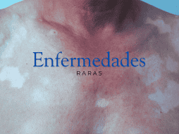 Esta enfermedad presenta alteraciones de coloración como hiperpigmentación o manchas similares al vitíligo. ESPECIAL / CANVA