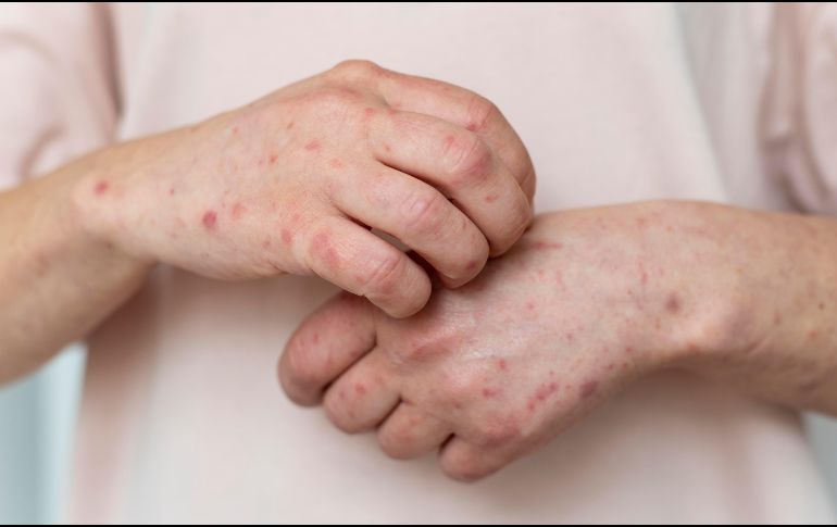 Uno de los síntomas visibles es la erupción en la piel, inicia en la cara y se extiende al resto del cuerpo. FREEPIK