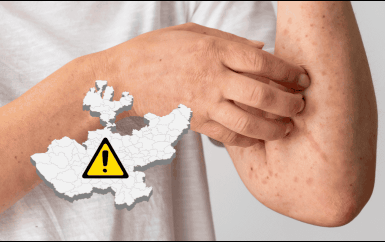 Hasta el corte más reciente de la dependencia estatal, sumaban 136 casos confirmados de sarampión en la Entidad.CANVA