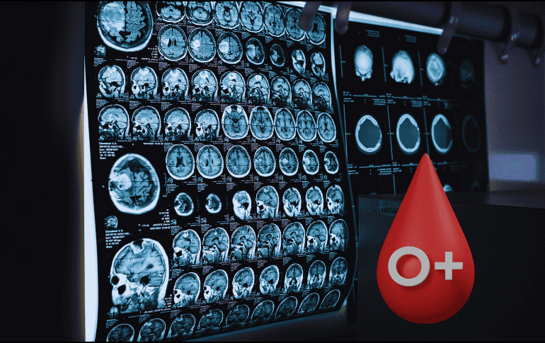 Las pruebas actuales de alzhéimer, como el análisis del líquido cefalorraquídeo o las técnicas de imagen cerebral (como el PET), son invasivas, caras o poco accesibles. ESPECIAL