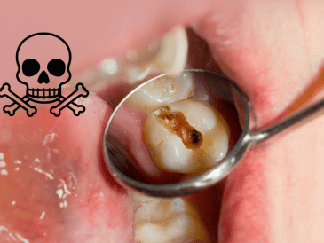 Existen factores que incrementan el riesgo de estas complicaciones, como la falta de atención odontológica, sistemas inmunológicos debilitados, enfermedades crónicas como la diabetes y el uso prolongado de ciertos medicamentos. CANVA