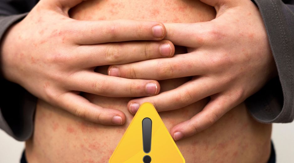 La Dirección General de Epidemiología apuntó que los casos graves son frecuentes en niños pequeños con malnutrición, y sobre todo en los que su sistema inmunitario está debilitado. ESPECIAL / CANVA