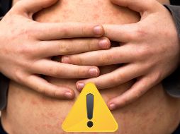 La Dirección General de Epidemiología apuntó que los casos graves son frecuentes en niños pequeños con malnutrición, y sobre todo en los que su sistema inmunitario está debilitado. ESPECIAL / CANVA