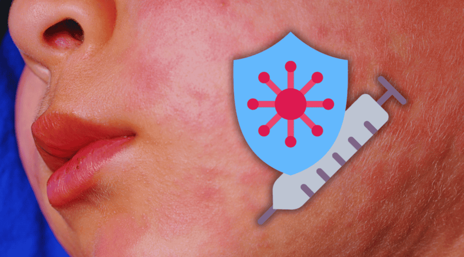 Ahora, Jalisco es el estado con mayor número de enfermos de sarampión en 2026, con 385 casos. ESPECIAL / CANVA