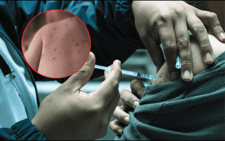 Actualmente, 26 personas se encuentran hospitalizadas a causa del sarampión. EL INFORMADOR/A. Navarro ESPECIAL/Gobierno de México