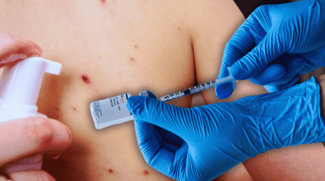 Jalisco ocupa el primer lugar nacional en lo que va del presente año en casos confirmados acumulados de sarampión, con 718. ESPECIAL / CANVA