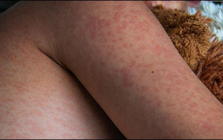 La Secretaría de Salud del estado de Tlaxcala informó el fallecimiento de un bebé de un año y un mes de edad a causa de complicaciones asociadas al sarampión. ESPECIAL / CANVA