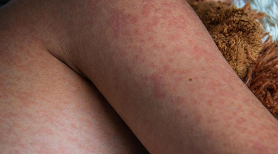 La Secretaría de Salud del estado de Tlaxcala informó el fallecimiento de un bebé de un año y un mes de edad a causa de complicaciones asociadas al sarampión. ESPECIAL / CANVA