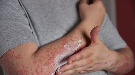 Con los cuidados adecuados, la mayoría de los casos se resuelven sin complicaciones graves. FREEPIk