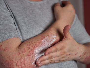 Con los cuidados adecuados, la mayoría de los casos se resuelven sin complicaciones graves. FREEPIk