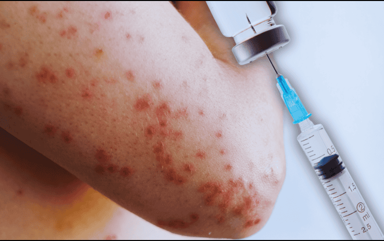 No hay tratamiento específico para el sarampión y la mayoría de los pacientes se recuperan en 2 o 3 semanas. ESPECIAL / CANVA