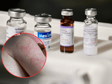 Jalisco ocupa actualmente el segundo lugar a nivel nacional en casos de sarampión registrados este año. ESPECIAL/Gobierno de Jalisco/Canva