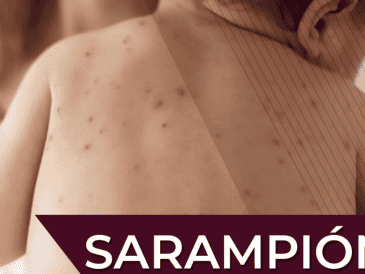 Las autoridades invitan a la población a acudir al  Centro de Salud o módulo de vacunación más cercano para recibir la vacuna contra el sarampión. Gobierno de México