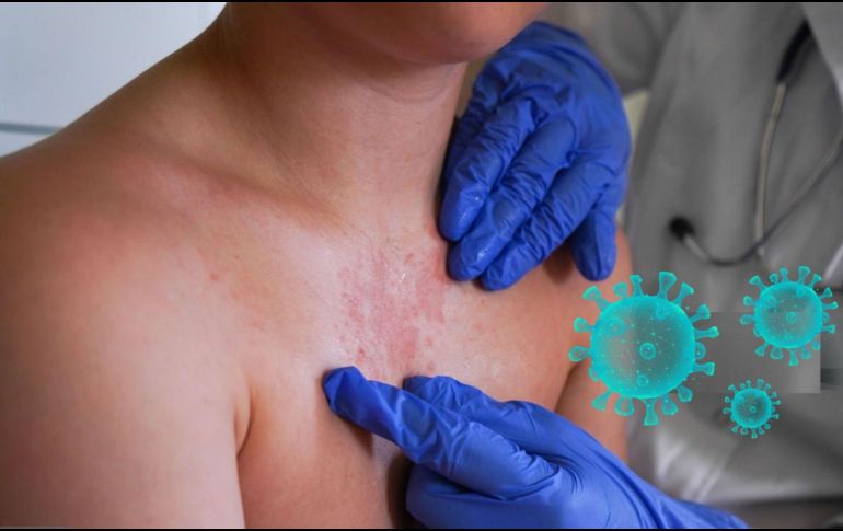 La manifestación clínica del sarampión ocurre días después del contagio inicial. PEXELS/ESPECIAL