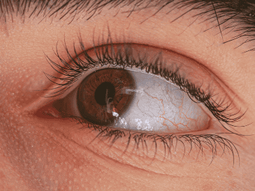 La miopía se desarrolla cuando la iluminación deficiente de la retina no genera una actividad retiniana sólida. ESPECIAL