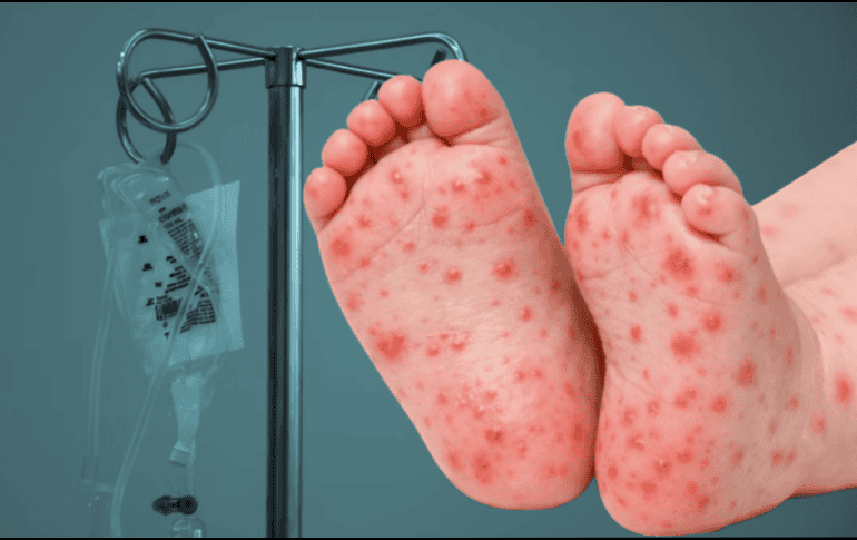 En un comunicado, la dependencia estatal precisó que, aunque no se cuenta con un diagnóstico confirmado por laboratorio, el hermano gemelo del menor dio positivo a la prueba de sarampión. Unsplash