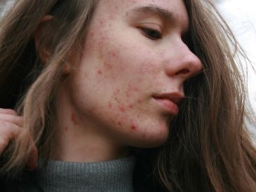 Los multivitamínicos son suplementos alimenticios y algunos pueden causar acné. UNSPLASH /  B. KRYSZTOFIAK