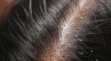 Recomiendan lavar el cabello y enjuagarlo correctamente, así como limitar el uso de productos cosméticos para peinar, ya que la grasa que contienen puede acumularse en el cuero cabelludo y empeorar la afección. ESPECIAL / CANVA
