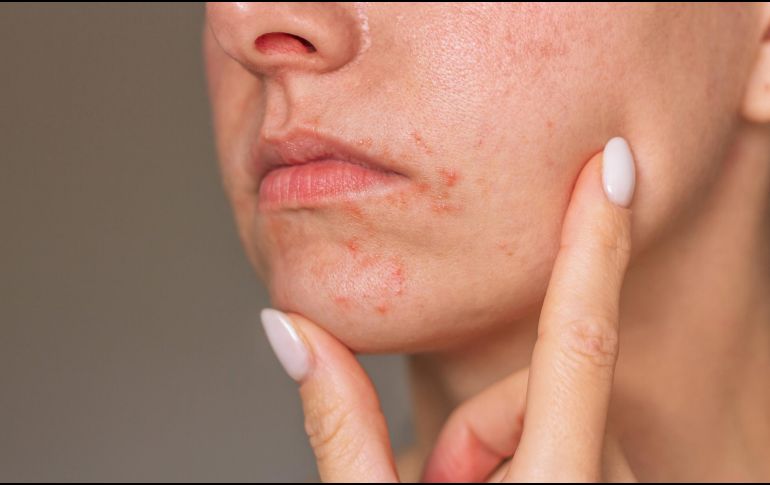 El estrés psicológico activa respuestas inmunitarias que agravan la dermatitis en la piel. ESPECIAL / CANVA