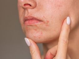 El estrés psicológico activa respuestas inmunitarias que agravan la dermatitis en la piel. ESPECIAL / CANVA