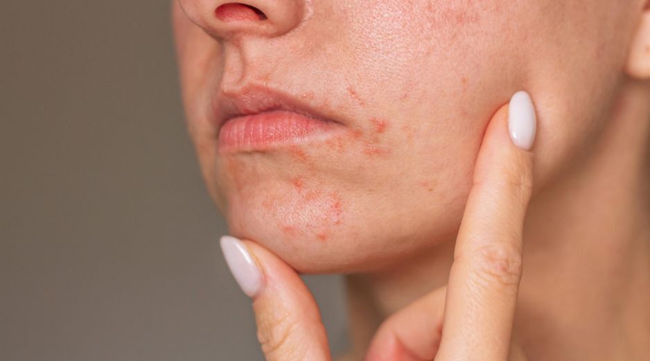 El estrés psicológico activa respuestas inmunitarias que agravan la dermatitis en la piel. ESPECIAL / CANVA