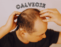 Las estadísticas sobre la calvicie a nivel mundial señalan que, a partir de los 25 años, 1 de cada 4 hombres comienza a sufrir pérdida de cabello. ESPECIAL / CANVA