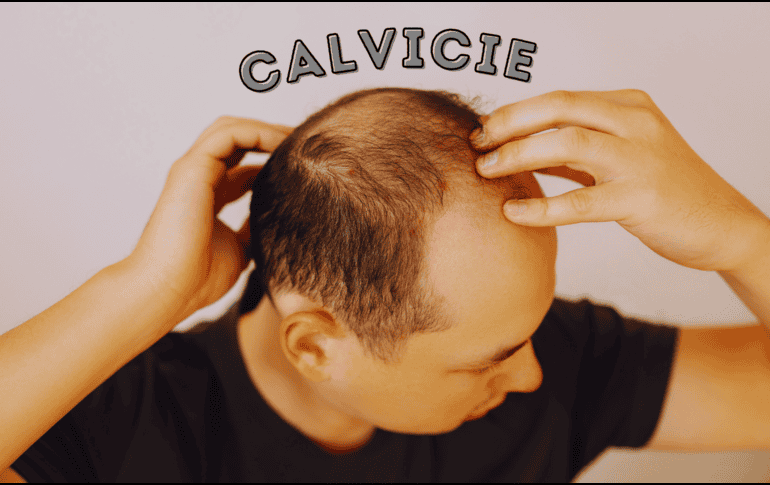 Las estadísticas sobre la calvicie a nivel mundial señalan que, a partir de los 25 años, 1 de cada 4 hombres comienza a sufrir pérdida de cabello. ESPECIAL / CANVA