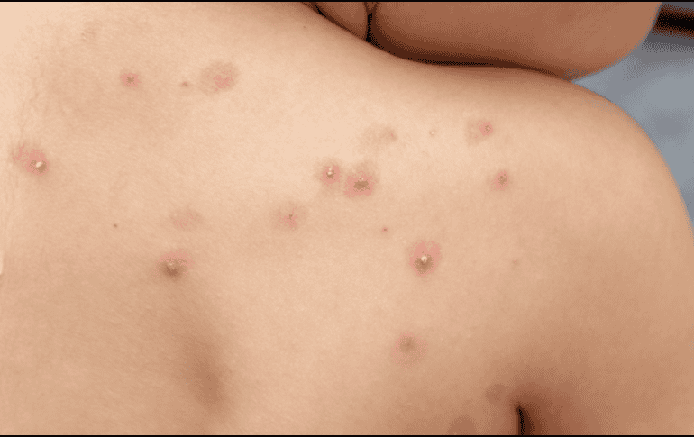 La situación epidemiológica en México ha mostrado variaciones importantes en los últimos meses, no obstante, para el primer trimestre de 2026, la Secretaría de Salud ha reportado una estabilización con 32 casos confirmados a nivel nacional. ESPECIAL